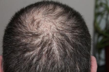 Reasons for hair loss and tips how to control hair fall